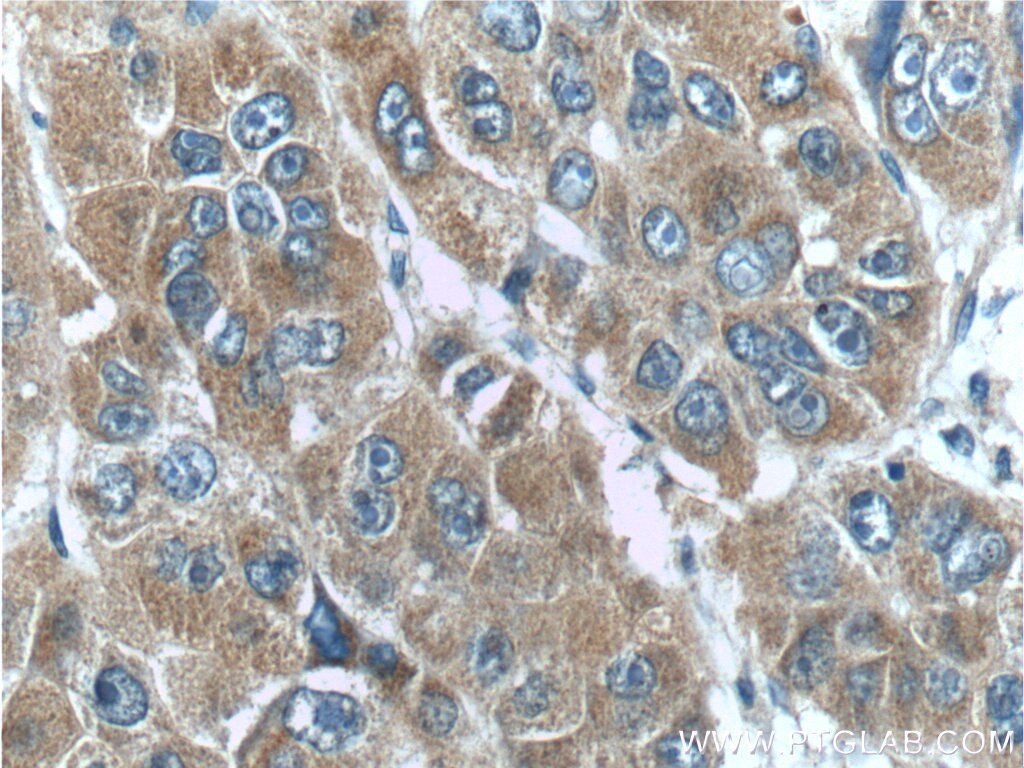 Immunohistochemistry (IHC) staining of human liver cancer tissue using ACOT12 Polyclonal antibody (17871-1-AP)