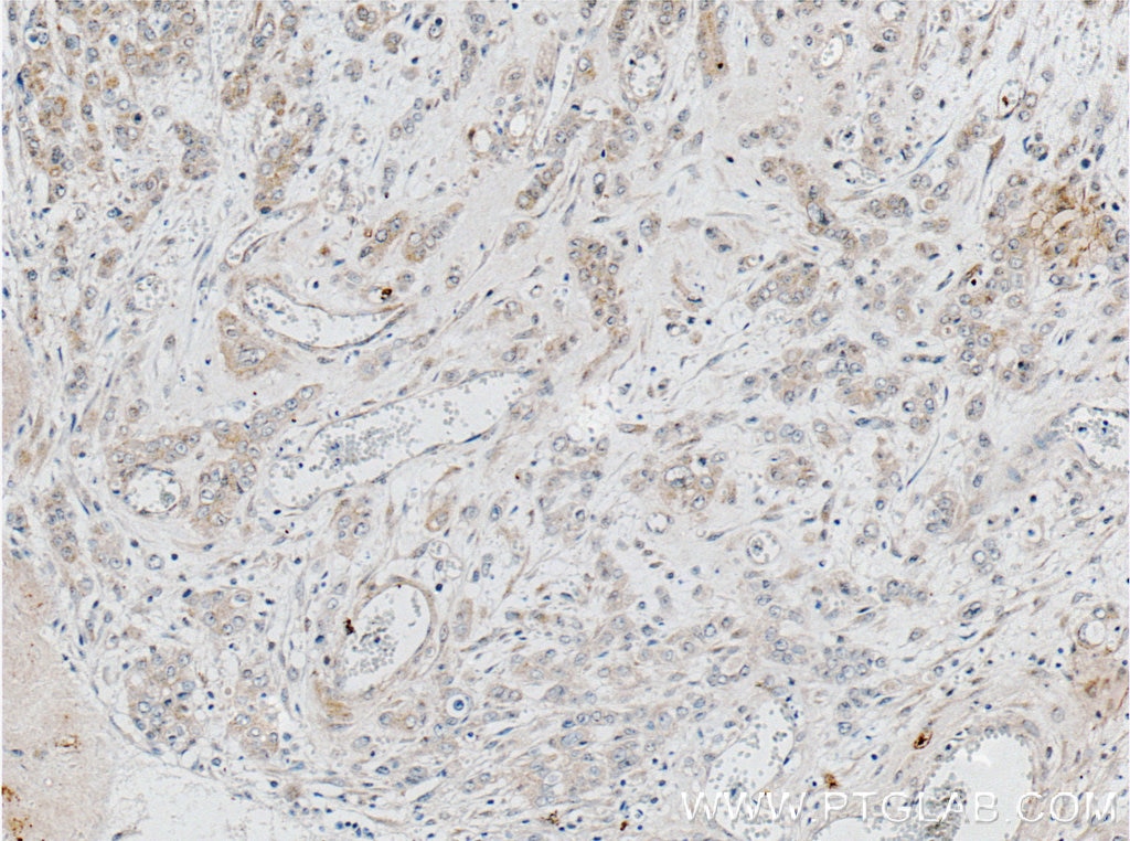 Immunohistochemistry (IHC) staining of human colon cancer tissue using ACOT9 Monoclonal antibody (66532-1-Ig)
