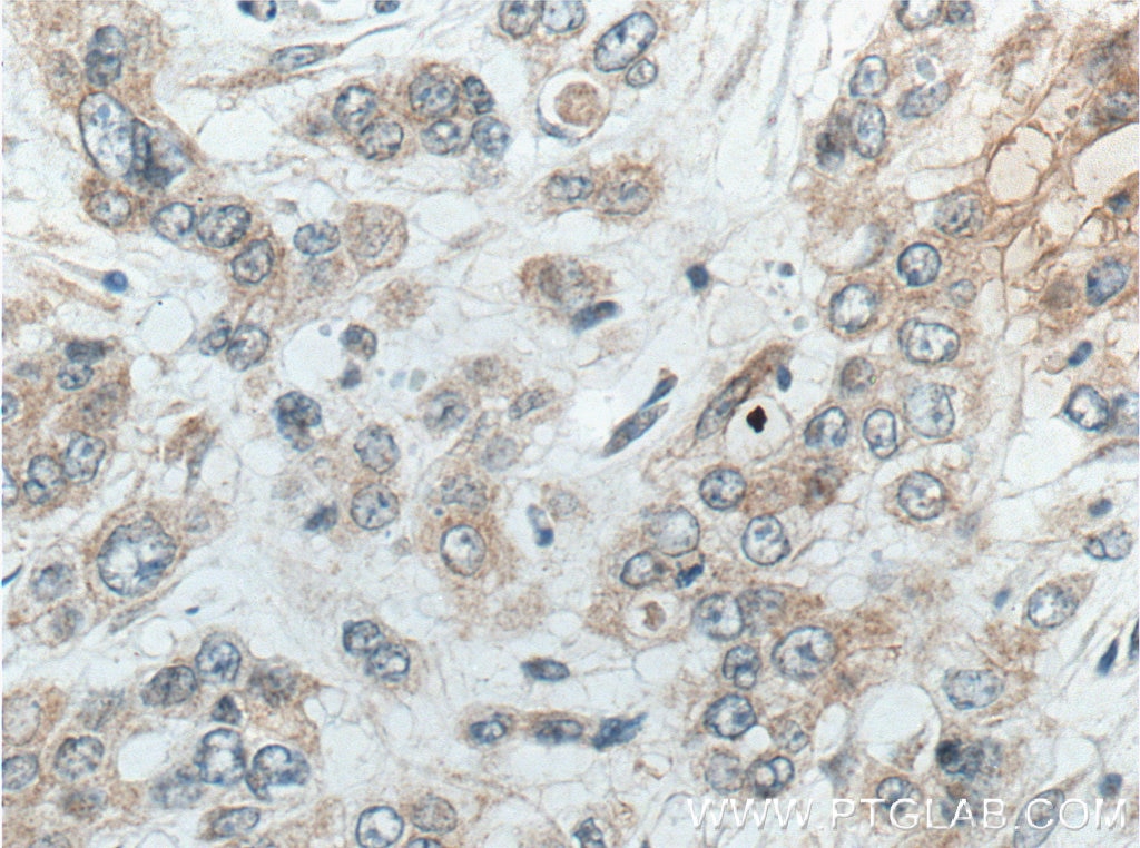 Immunohistochemistry (IHC) staining of human colon cancer tissue using ACOT9 Monoclonal antibody (66532-1-Ig)
