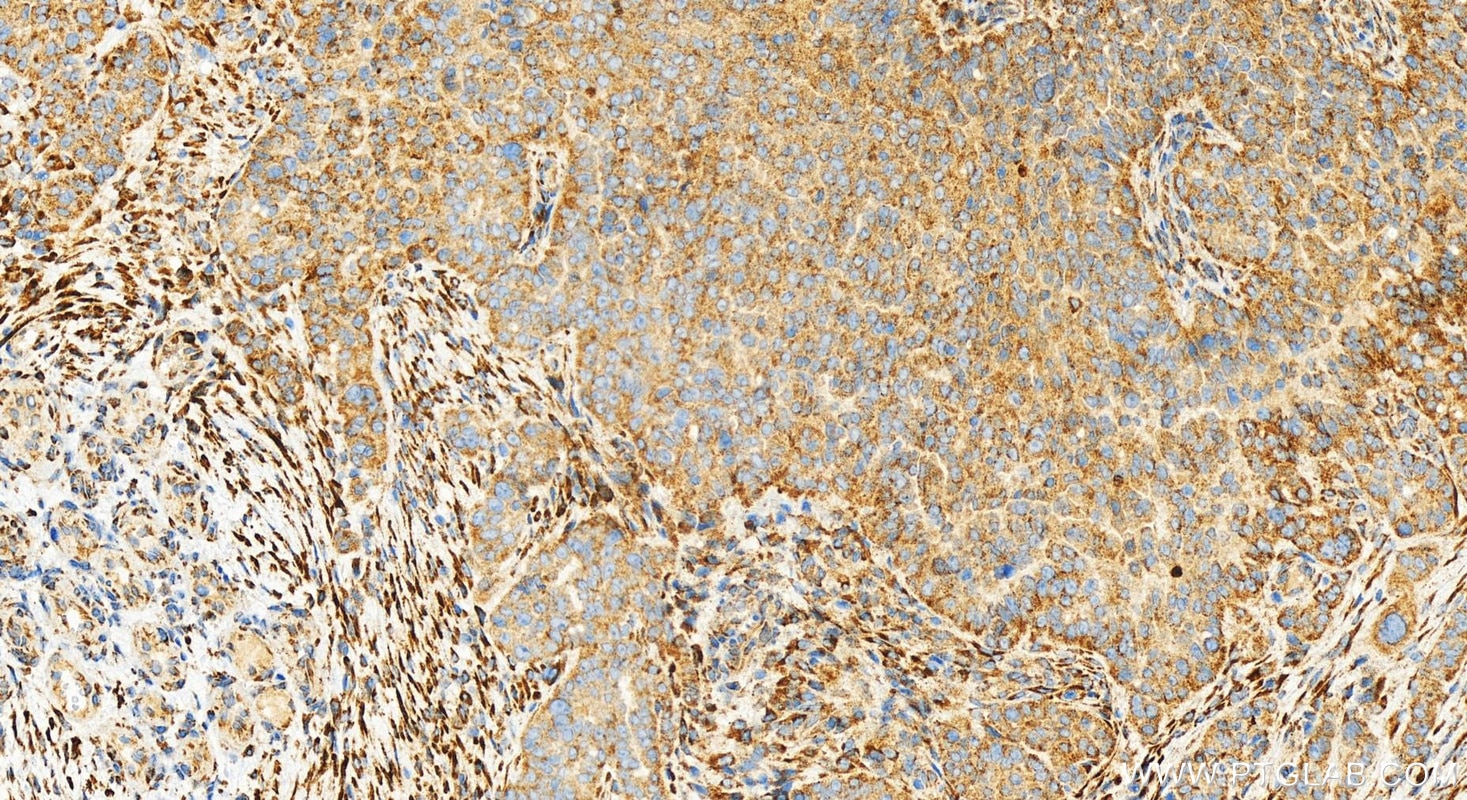 Immunohistochemistry (IHC) staining of human ovarian  cancer using ACOX1 Recombinant monoclonal antibody (83731-2-RR)
