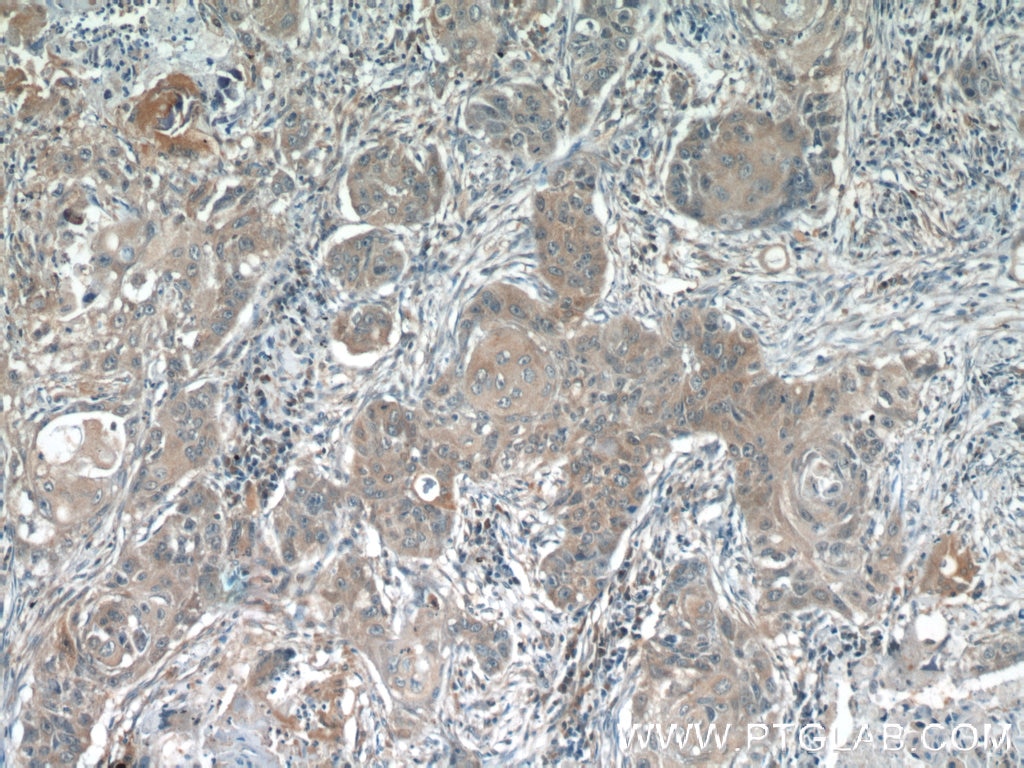 IHC staining of human lung cancer using 22214-1-AP