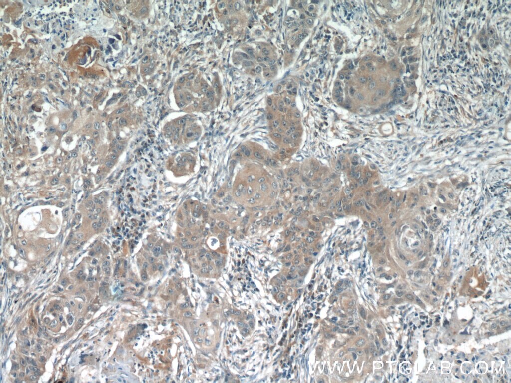 Immunohistochemistry (IHC) staining of human lung cancer tissue using ACP1 Polyclonal antibody (22214-1-AP)