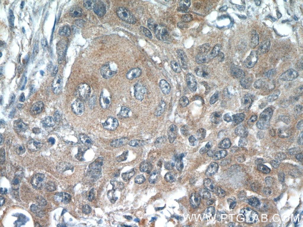 Immunohistochemistry (IHC) staining of human lung cancer tissue using ACP1 Polyclonal antibody (22214-1-AP)