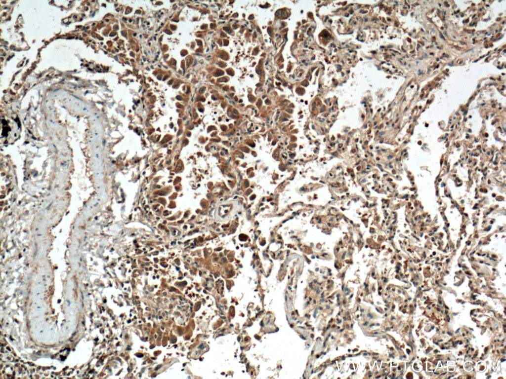 IHC staining of human lung cancer using 22214-1-AP