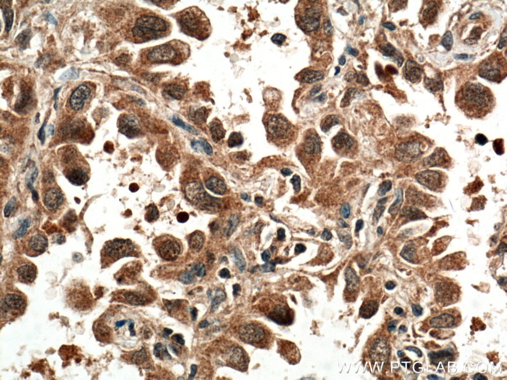 Immunohistochemistry (IHC) staining of human lung cancer tissue using ACP1 Polyclonal antibody (22214-1-AP)