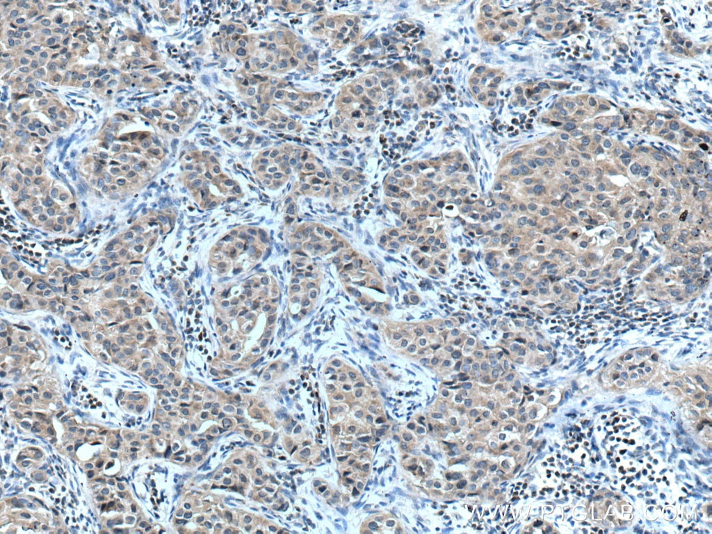 Immunohistochemistry (IHC) staining of human breast cancer tissue using ACP1 Polyclonal antibody (22214-1-AP)