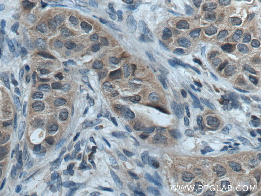 Immunohistochemistry (IHC) staining of human breast cancer tissue using ACP1 Polyclonal antibody (22214-1-AP)