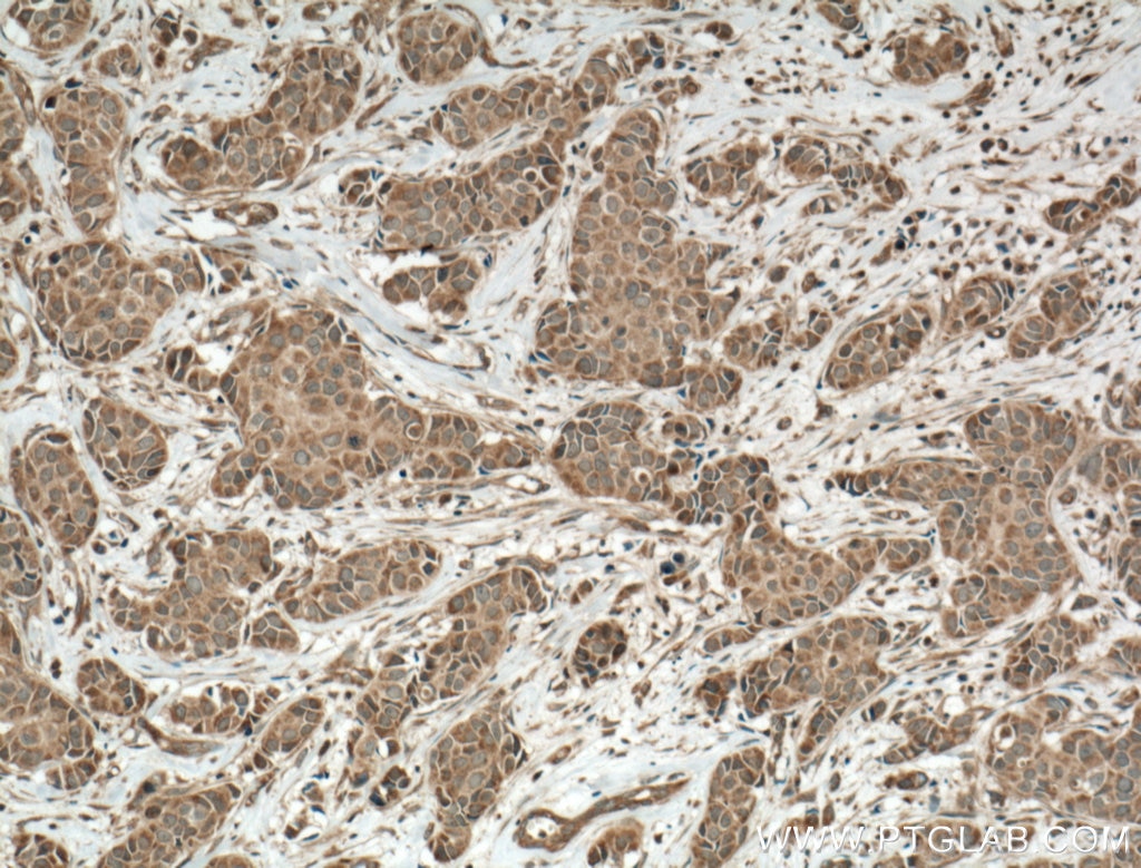 Immunohistochemistry (IHC) staining of human breast cancer tissue using ACP5 Polyclonal antibody (11594-1-AP)
