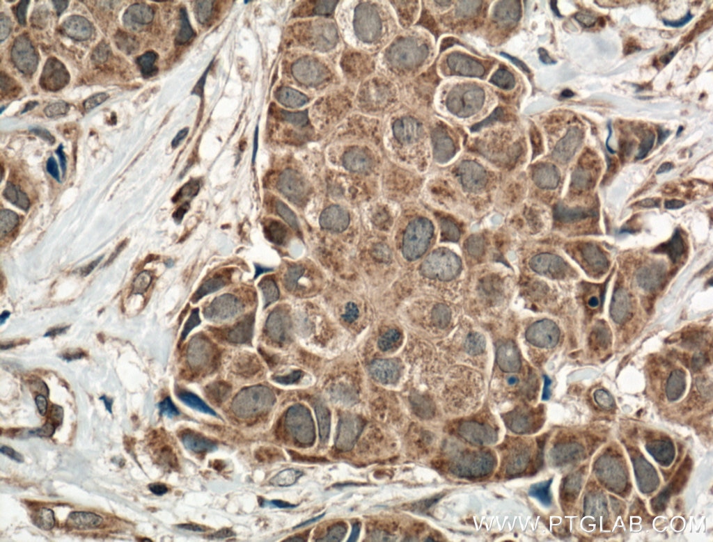 Immunohistochemistry (IHC) staining of human breast cancer tissue using ACP5 Polyclonal antibody (11594-1-AP)