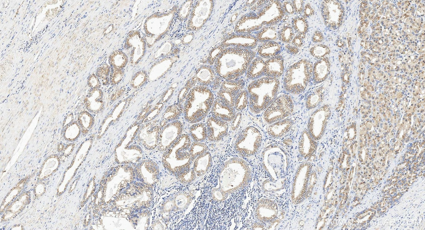 Immunohistochemistry (IHC) staining of human prostate cancer tissue using ACP6 Polyclonal antibody (12965-1-AP)
