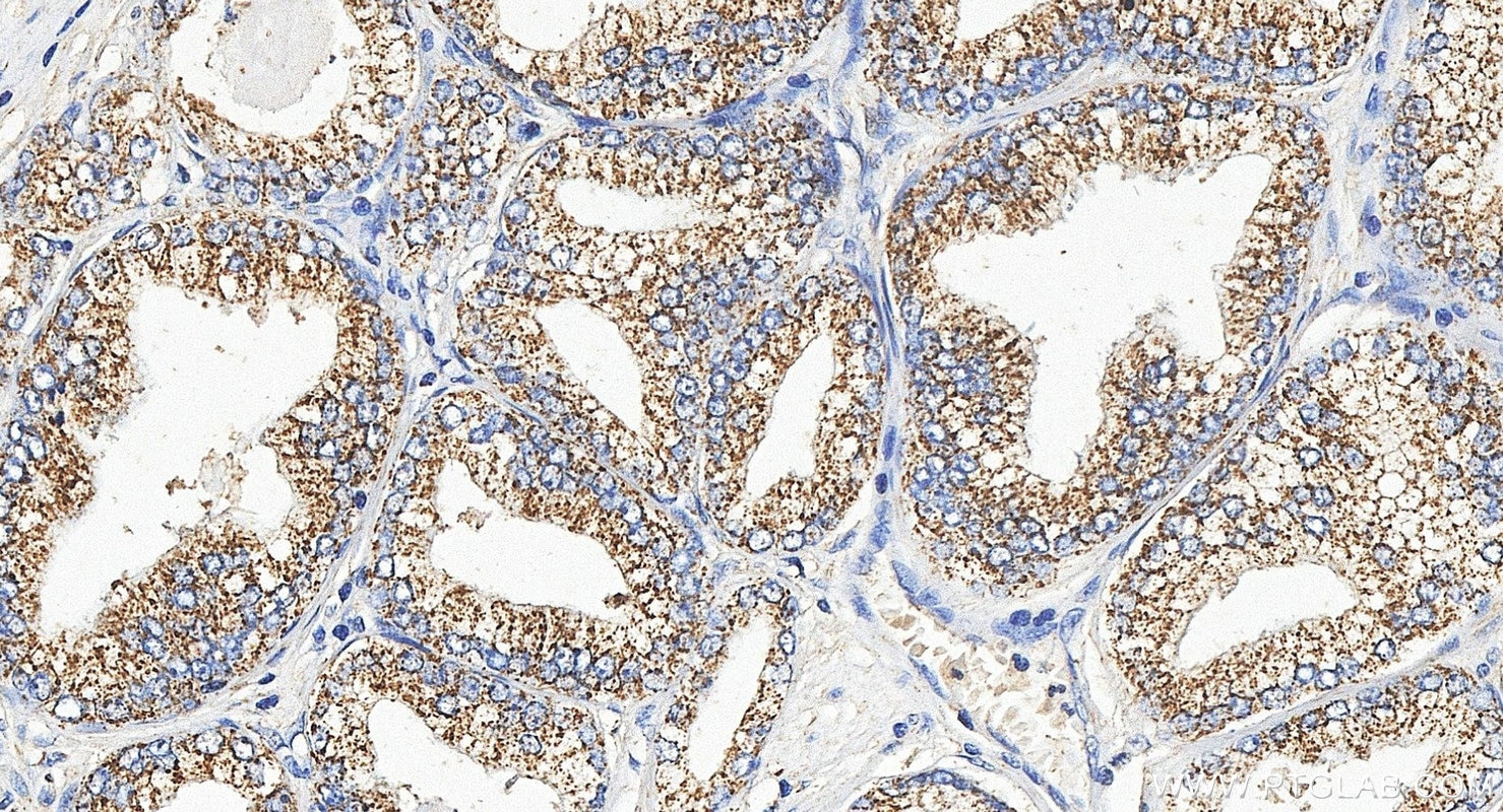 Immunohistochemistry (IHC) staining of human prostate cancer tissue using ACP6 Polyclonal antibody (12965-1-AP)