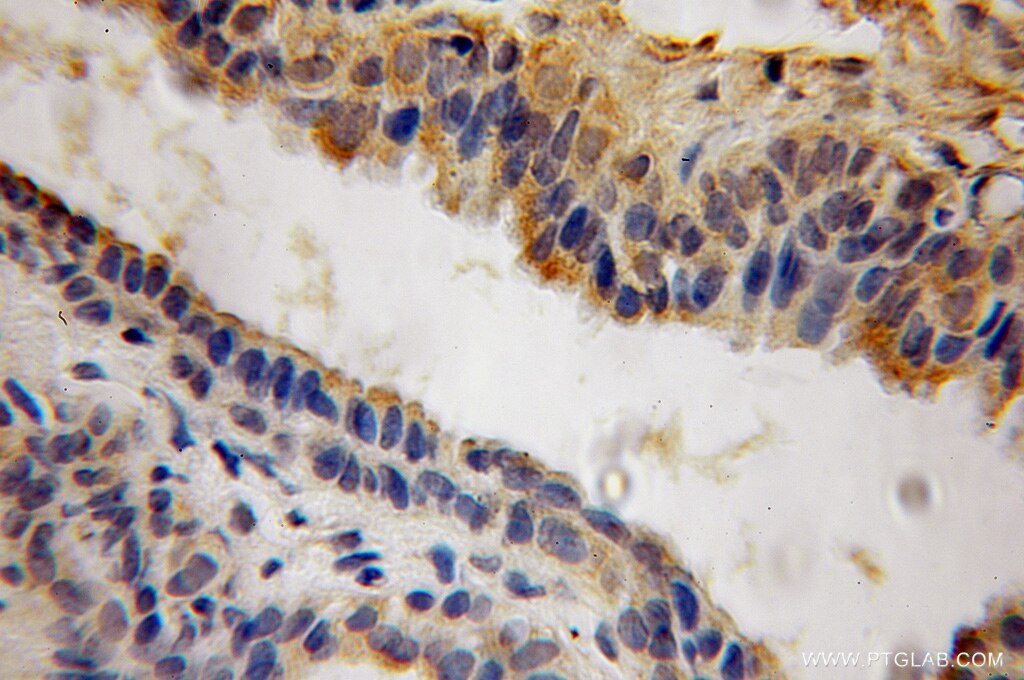 Immunohistochemistry (IHC) staining of human prostate cancer tissue using ACP6 Polyclonal antibody (12965-1-AP)