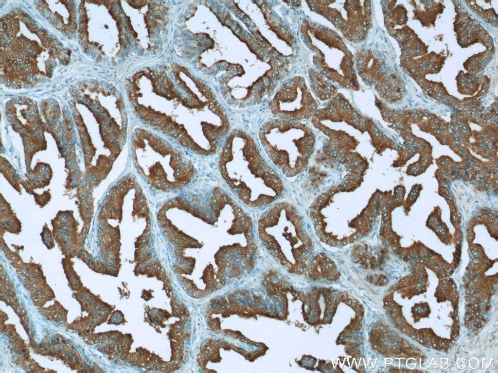 Immunohistochemistry (IHC) staining of human prostate hyperplasia tissue using ACPP Polyclonal antibody (15840-1-AP)