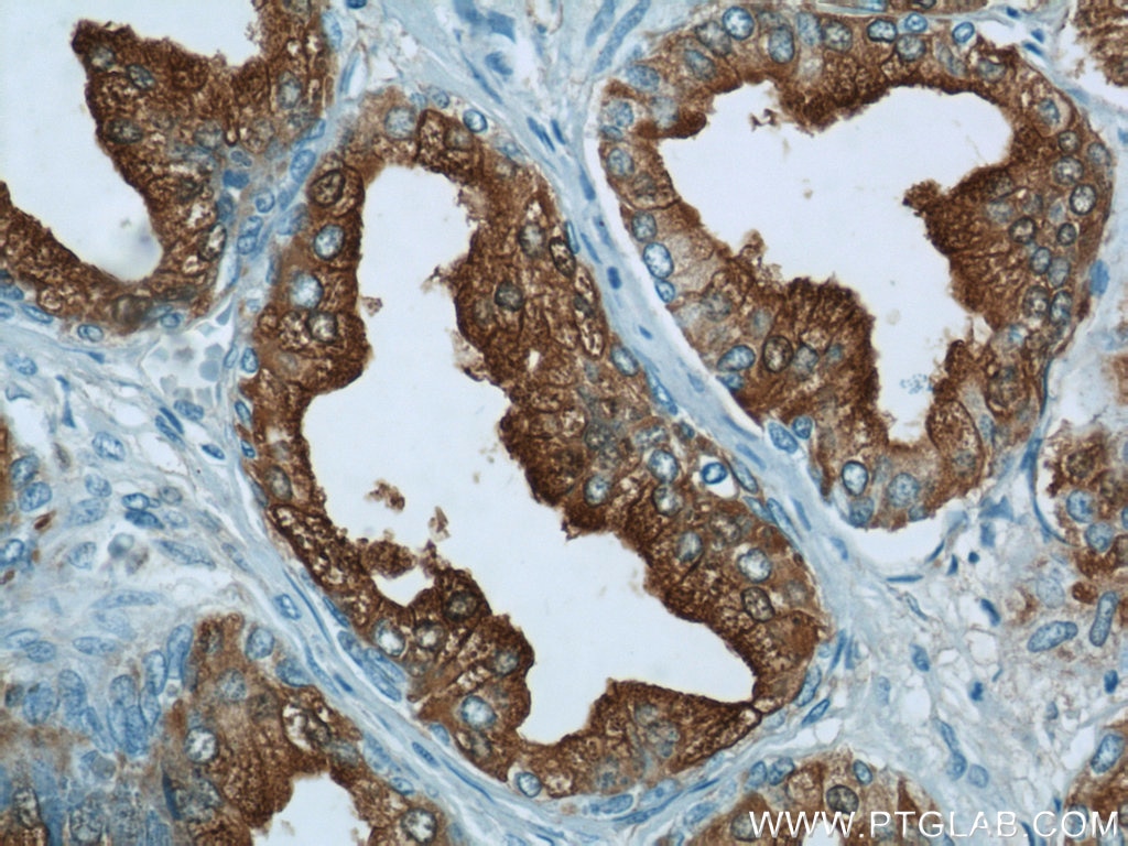 Immunohistochemistry (IHC) staining of human prostate hyperplasia tissue using ACPP Polyclonal antibody (15840-1-AP)