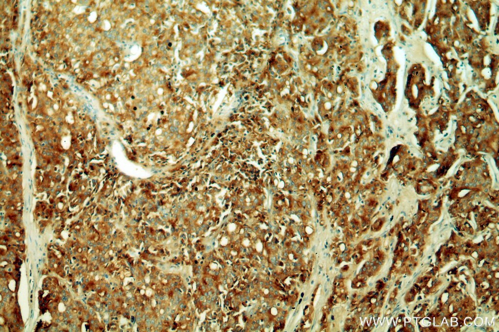 Immunohistochemistry (IHC) staining of human prostate cancer tissue using ACPP Polyclonal antibody (15840-1-AP)