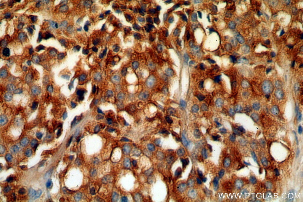 Immunohistochemistry (IHC) staining of human prostate cancer tissue using ACPP Polyclonal antibody (15840-1-AP)