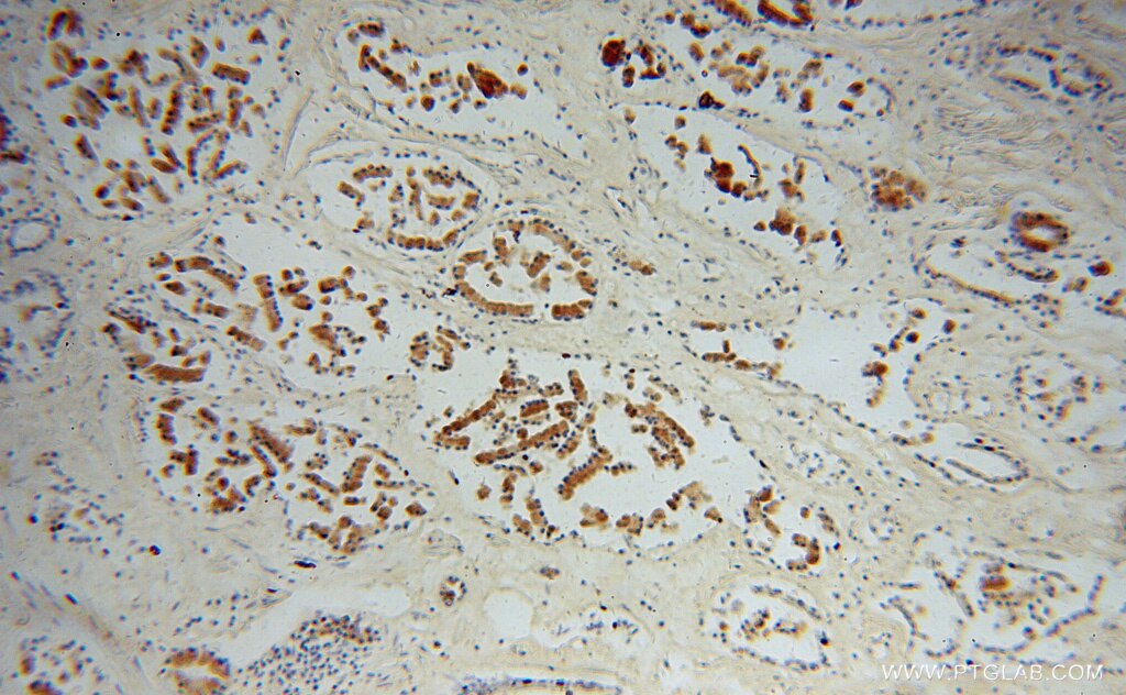 Immunohistochemistry (IHC) staining of human prostate cancer tissue using ACPP Polyclonal antibody (15840-1-AP)