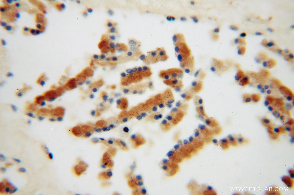 Immunohistochemistry (IHC) staining of human prostate cancer tissue using ACPP Polyclonal antibody (15840-1-AP)