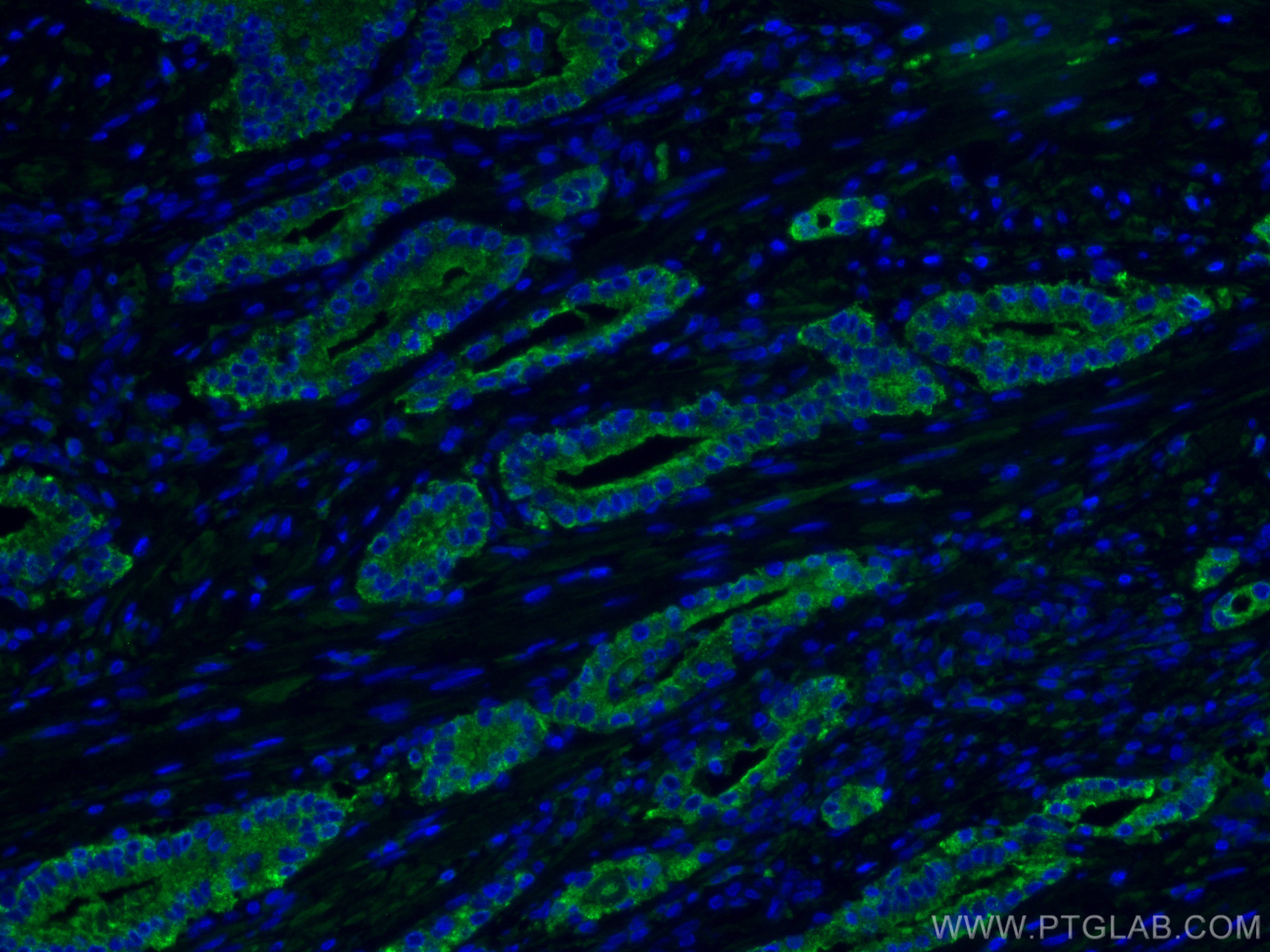 Immunofluorescence (IF) / fluorescent staining of human prostate cancer tissue using ACPP Monoclonal antibody (60176-1-Ig)