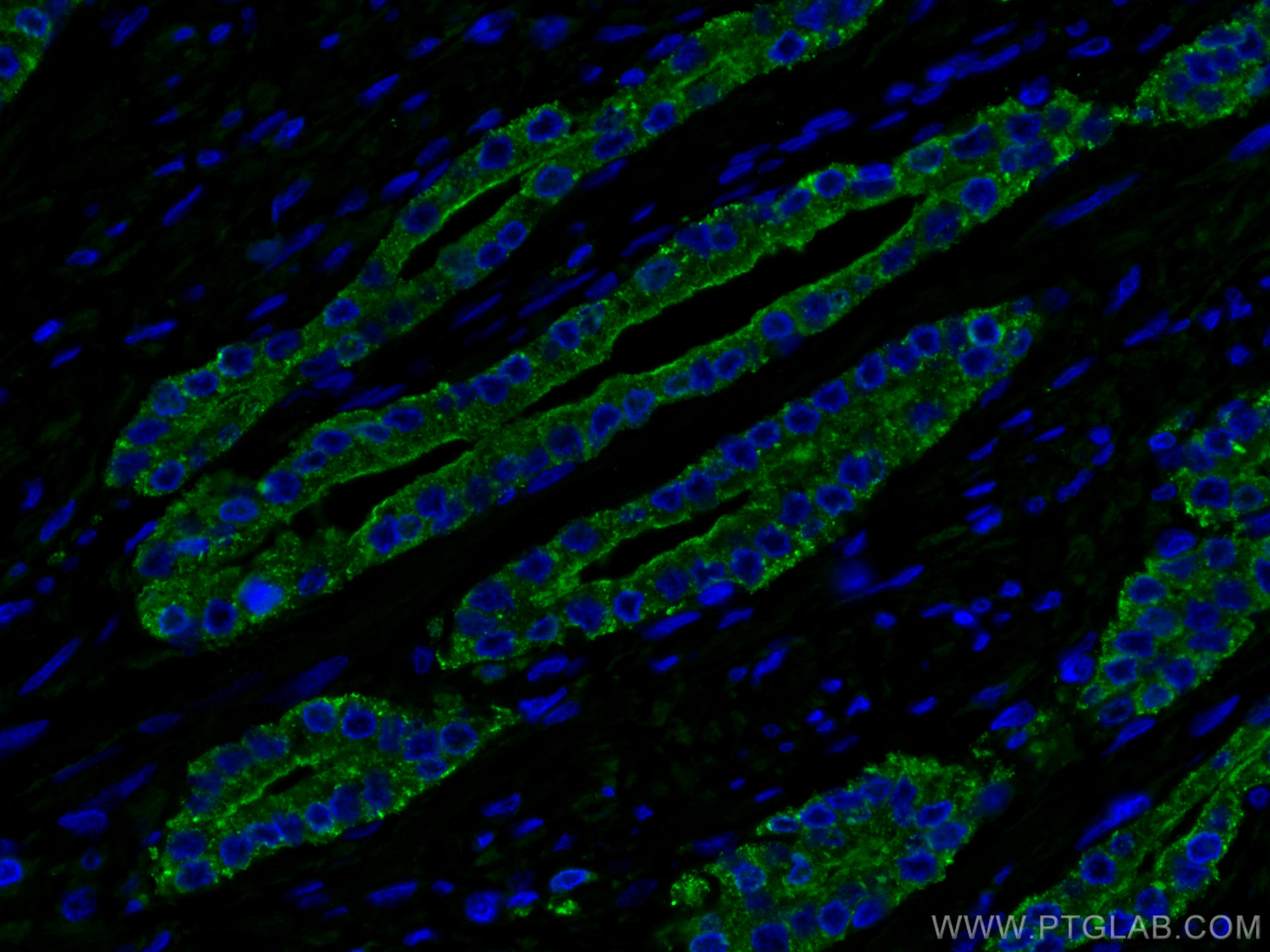 Immunofluorescence (IF) / fluorescent staining of human prostate cancer tissue using ACPP Monoclonal antibody (60176-1-Ig)