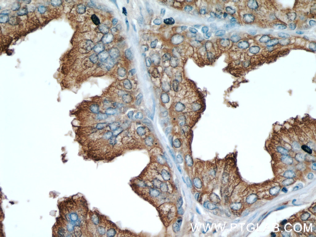 IHC staining of human prostate hyperplasia using 60176-1-Ig