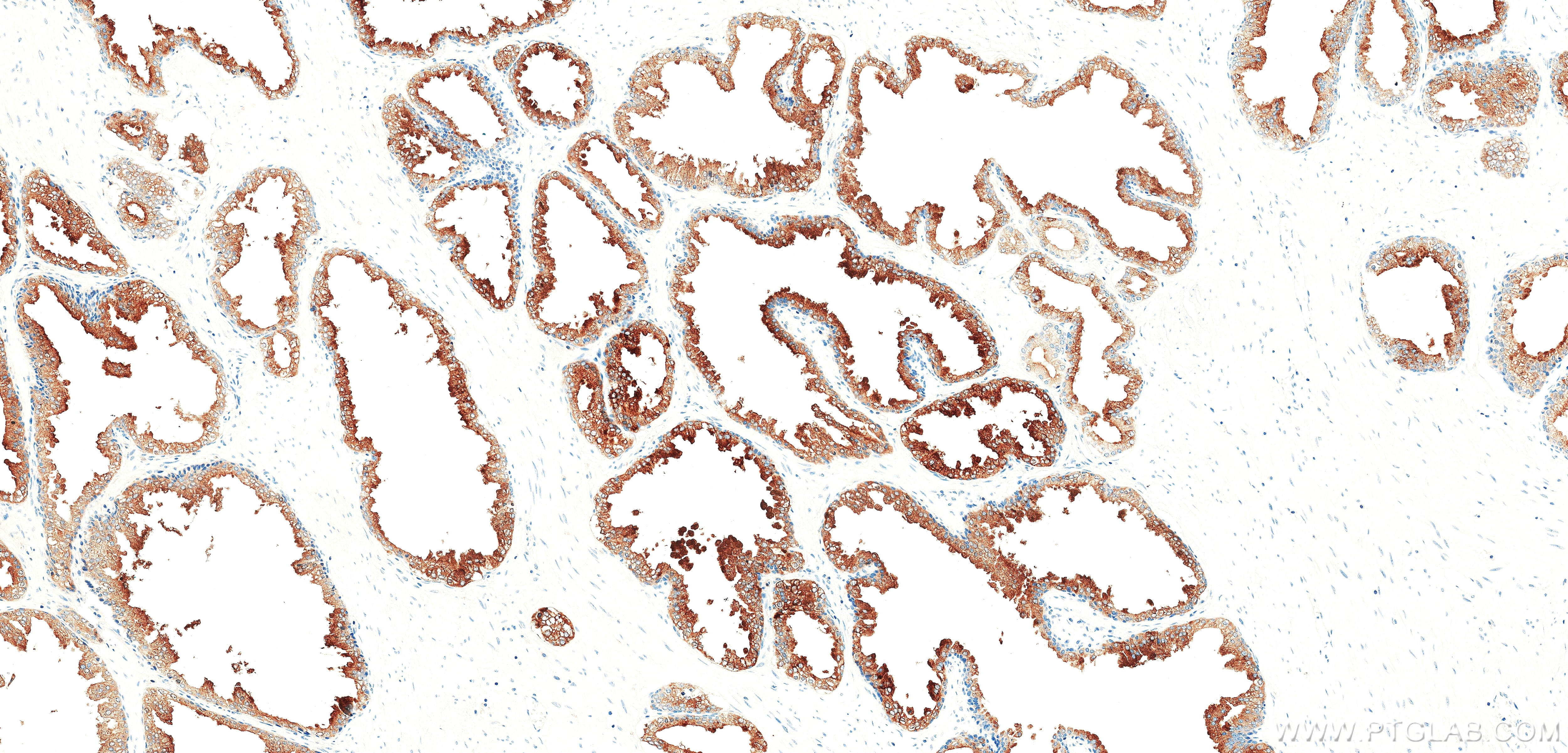 IHC staining of human prostate using 87842-1-RR (same clone as 87842-1-PBS) Immunohistochemistry (IHC) staining of human prostate tissue using ACPP Recombinant monoclonal antibody (87842-1-RR)