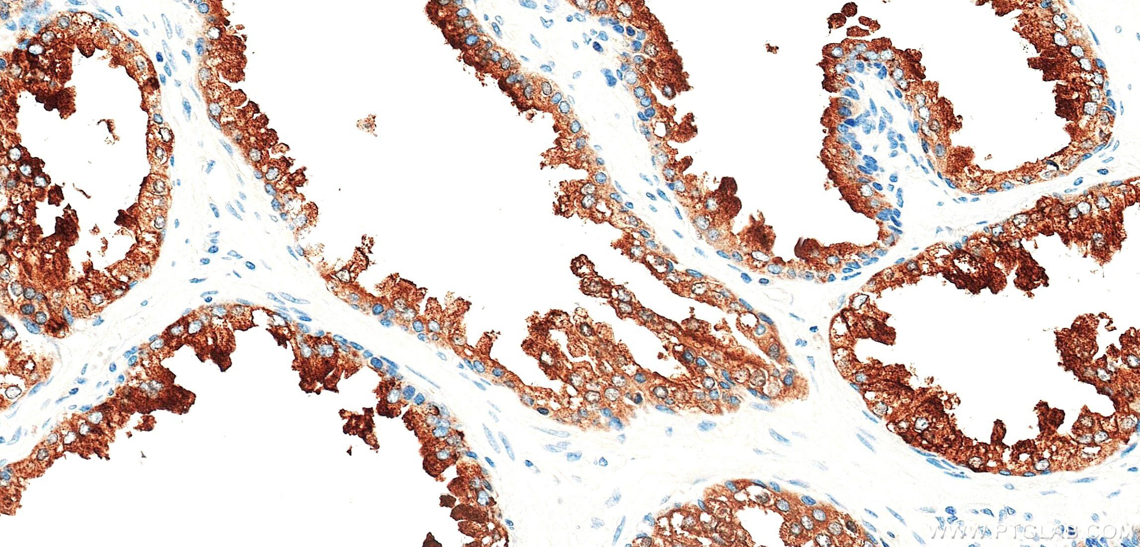IHC staining of human prostate using 87842-1-RR (same clone as 87842-1-PBS) Immunohistochemistry (IHC) staining of human prostate tissue using ACPP Recombinant monoclonal antibody (87842-1-RR)