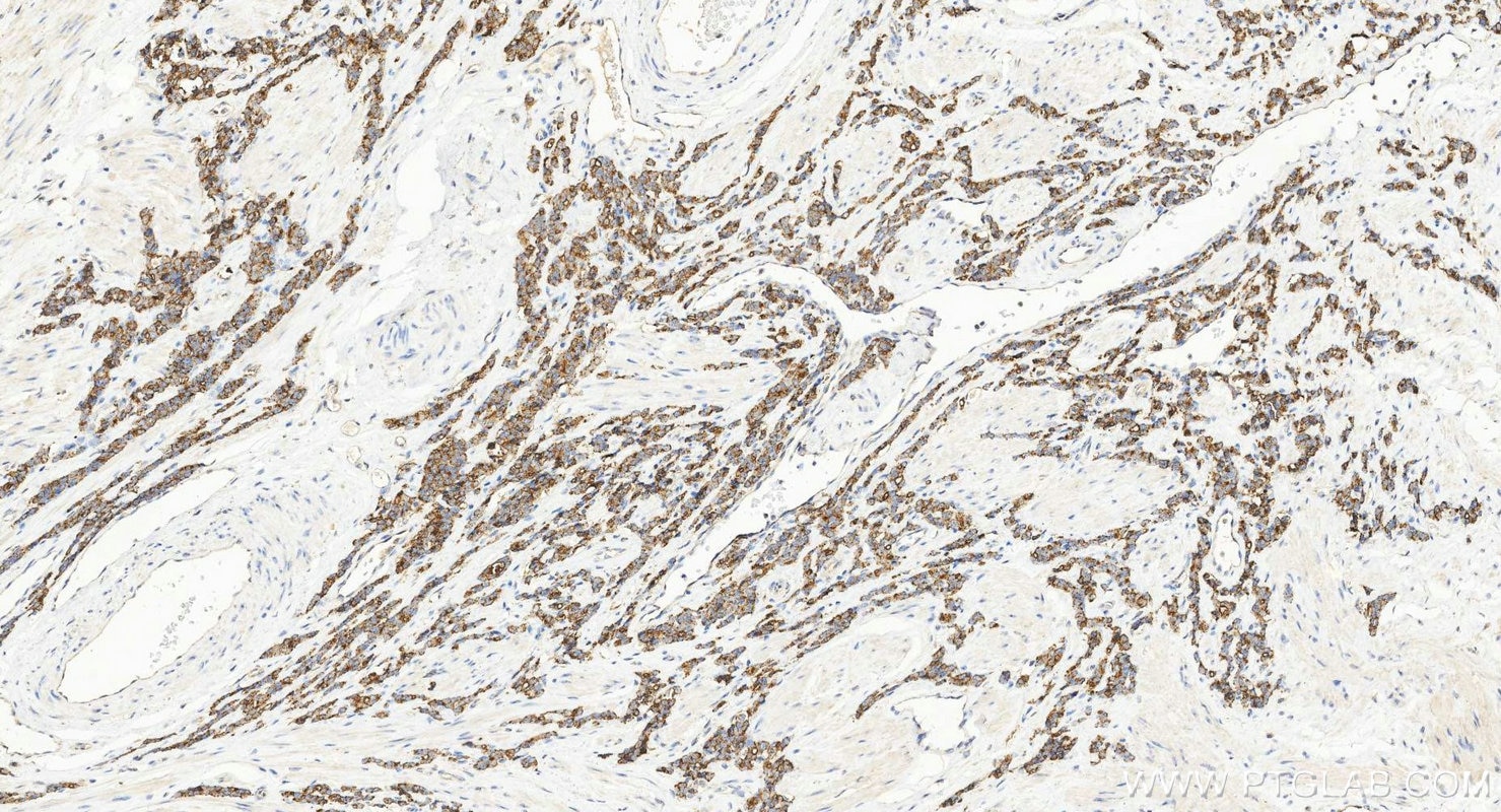 Immunohistochemistry (IHC) staining of human prostate cancer tissue using Biotin-conjugated ACPP Monoclonal antibody (Biotin-60176)