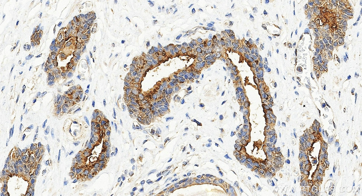 Immunohistochemistry (IHC) staining of human prostate cancer tissue using Biotin-conjugated ACPP Monoclonal antibody (Biotin-60176)