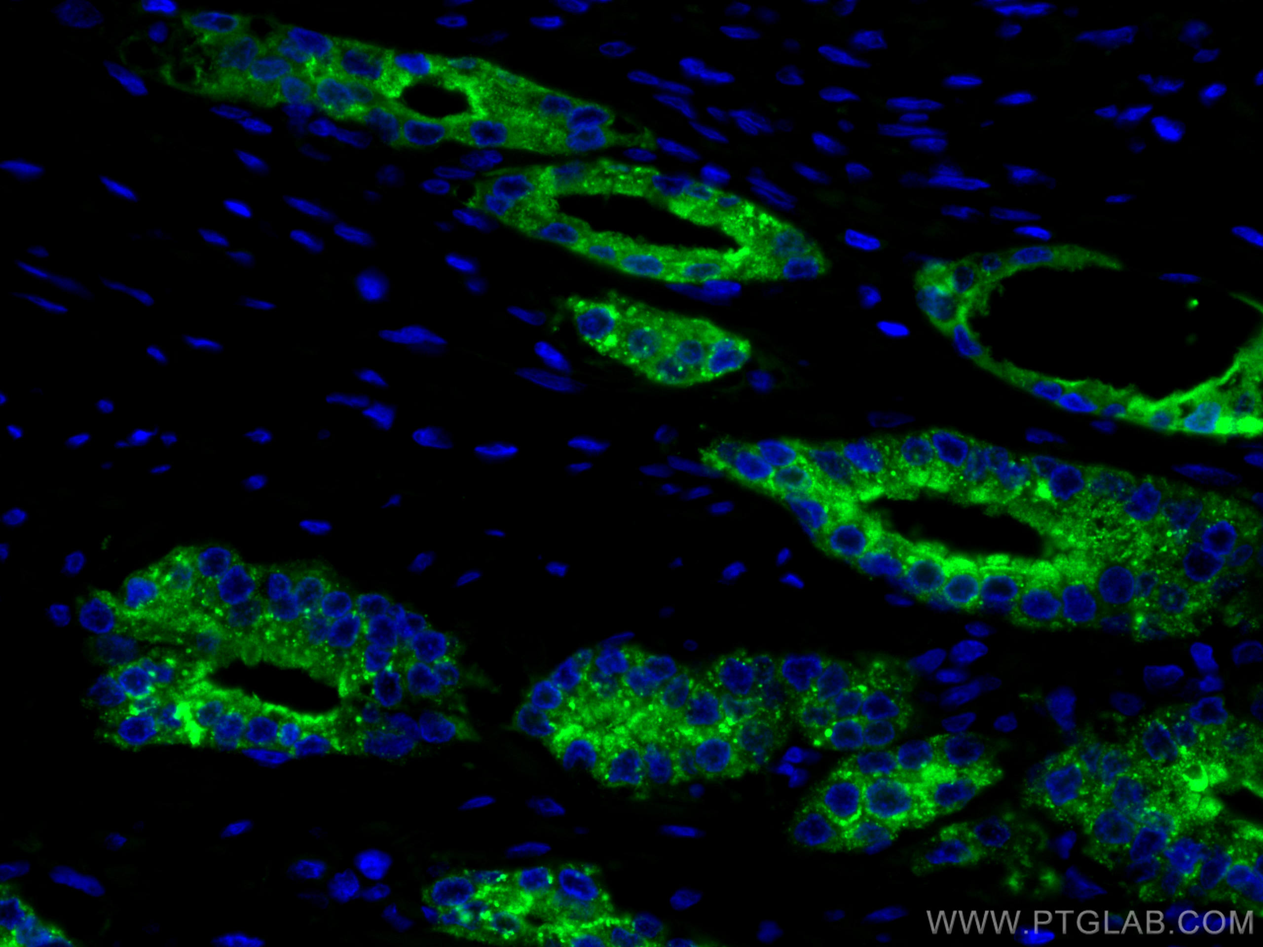 Immunofluorescence (IF) / fluorescent staining of human prostate cancer tissue using CoraLite® Plus 488-conjugated ACPP Monoclonal anti (CL488-60176)