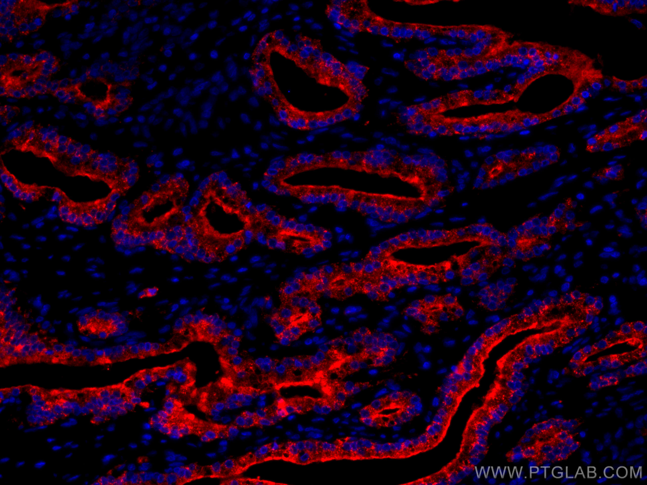 Immunofluorescence (IF) / fluorescent staining of human prostate cancer tissue using CoraLite®594-conjugated ACPP Monoclonal antibody (CL594-60176)