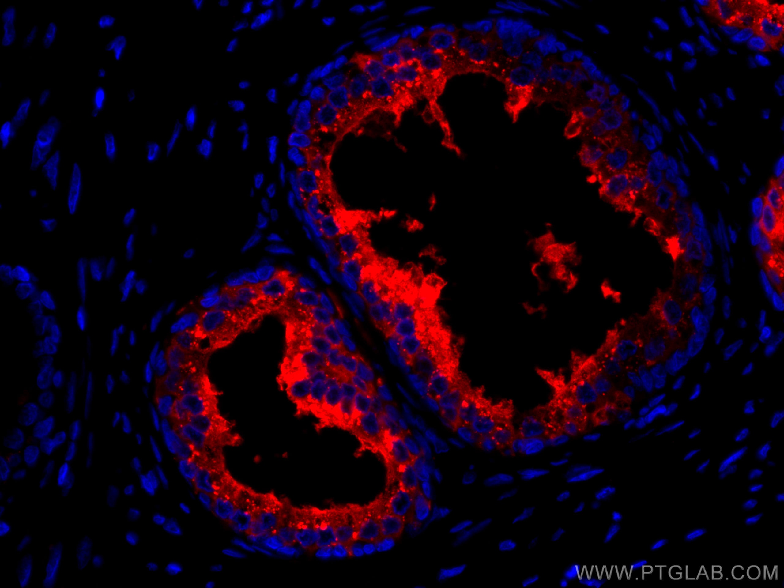 Immunofluorescence (IF) / fluorescent staining of human prostate cancer tissue using CoraLite®594-conjugated ACPP Monoclonal antibody (CL594-60176)