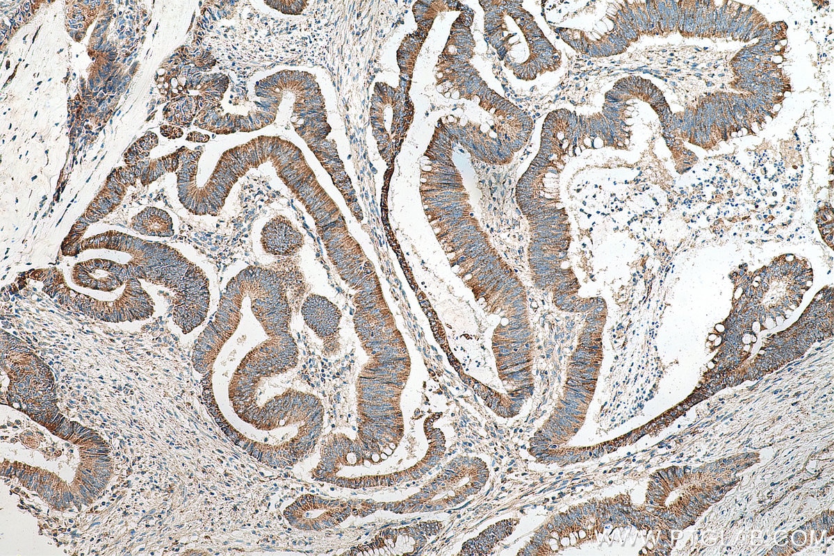 Immunohistochemistry (IHC) staining of human colon cancer tissue using ACSF2 Polyclonal antibody (16140-1-AP)