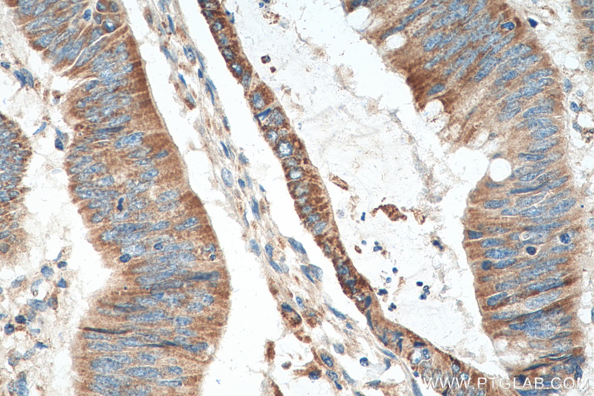 IHC staining of human colon cancer using 16140-1-AP