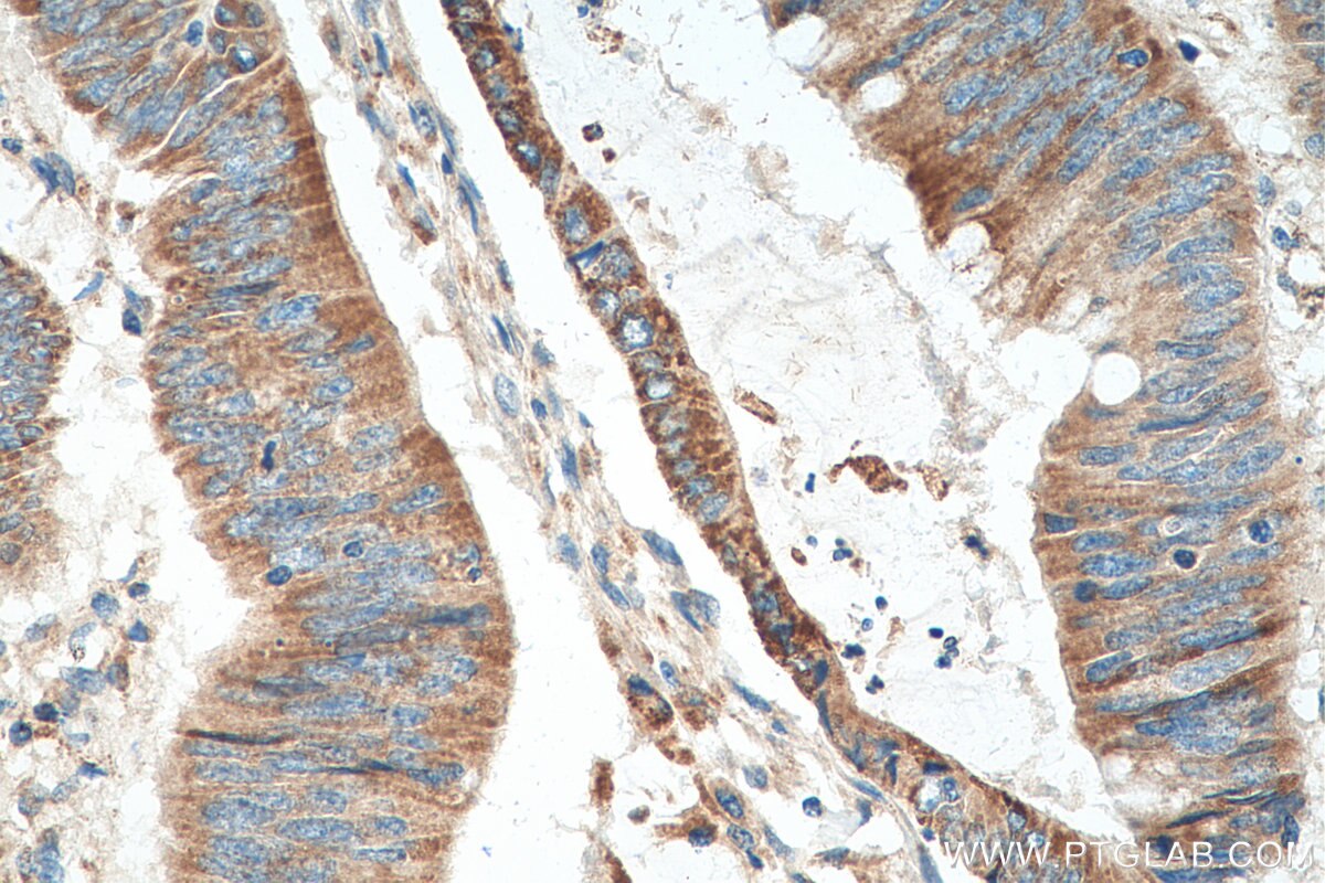 Immunohistochemistry (IHC) staining of human colon cancer tissue using ACSF2 Polyclonal antibody (16140-1-AP)