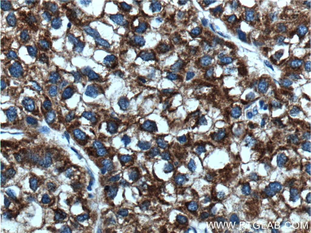 Immunohistochemistry (IHC) staining of human liver cancer tissue using ACSL1 Polyclonal antibody (13989-1-AP)
