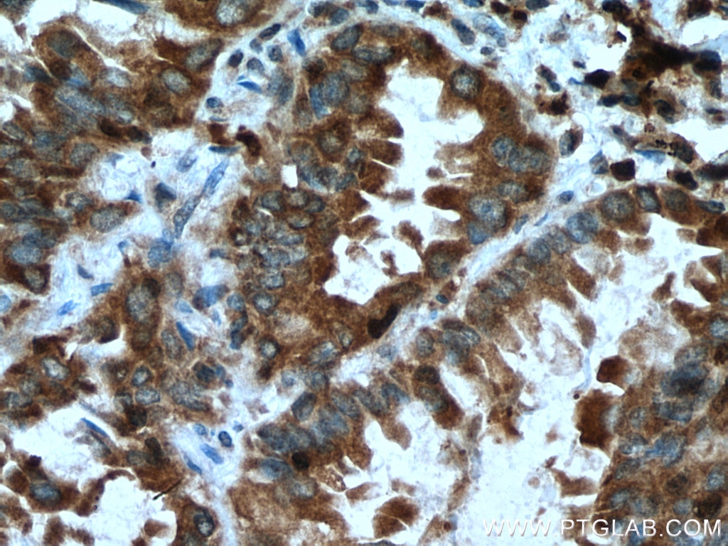 Immunohistochemistry (IHC) staining of human lung cancer tissue using ACSL1 Polyclonal antibody (13989-1-AP)