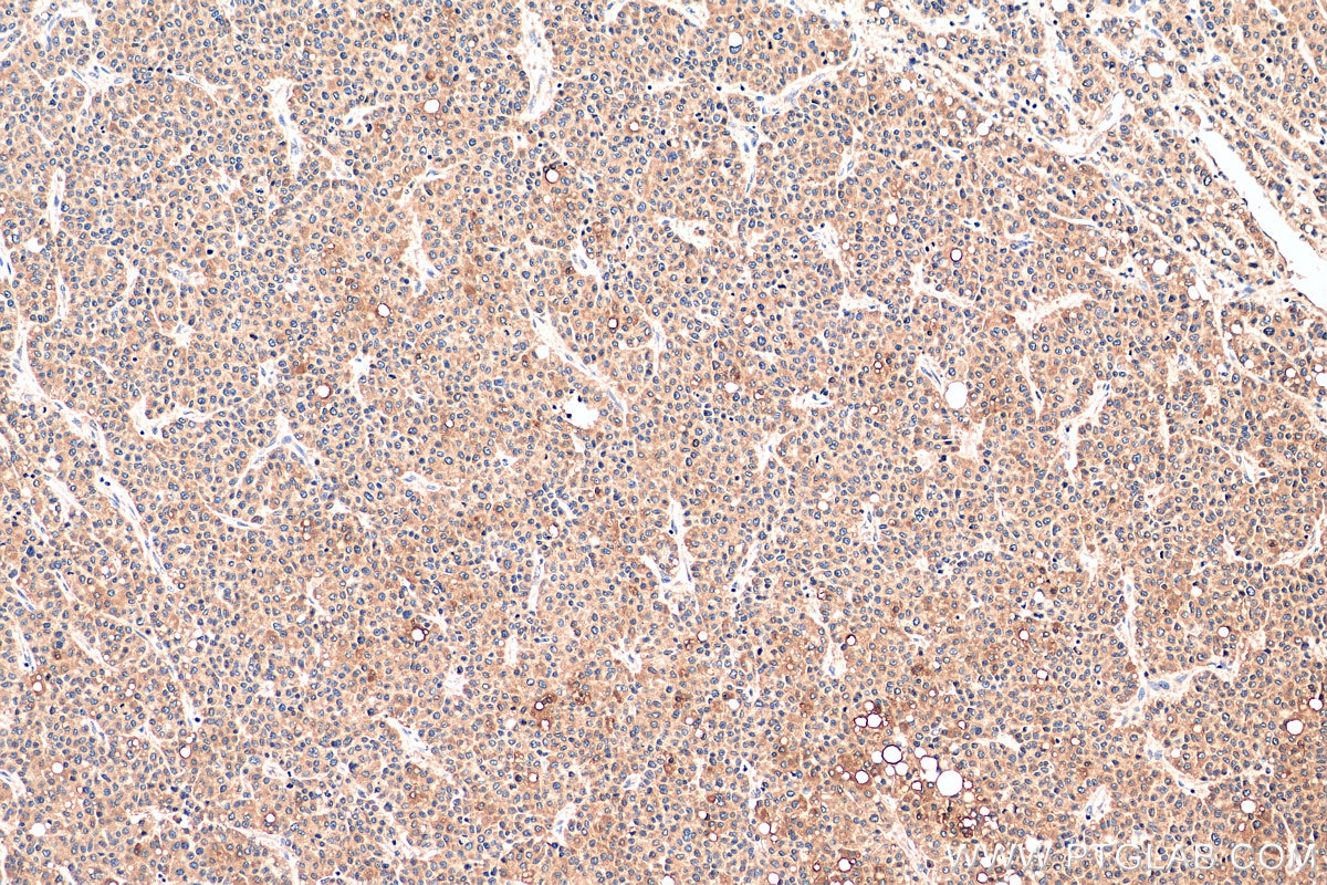 Immunohistochemistry (IHC) staining of human liver cancer tissue using ACSL4 Recombinant antibody (81196-1-RR)