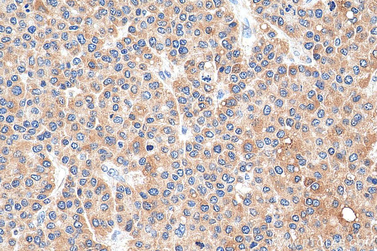 Immunohistochemistry (IHC) staining of human liver cancer tissue using ACSL4 Recombinant antibody (81196-1-RR)