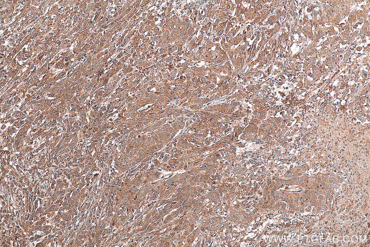 IHC staining of human stomach cancer using 81196-1-RR