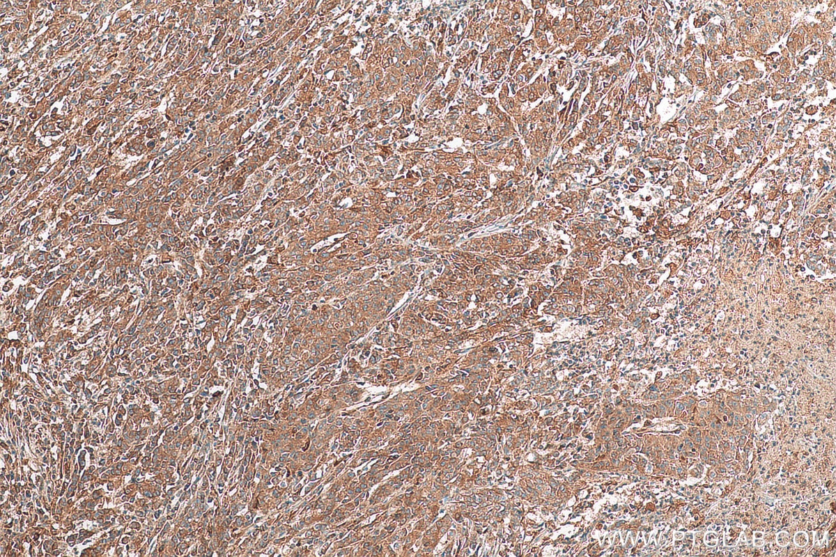 Immunohistochemistry (IHC) staining of human stomach cancer tissue using ACSL4 Recombinant antibody (81196-1-RR)