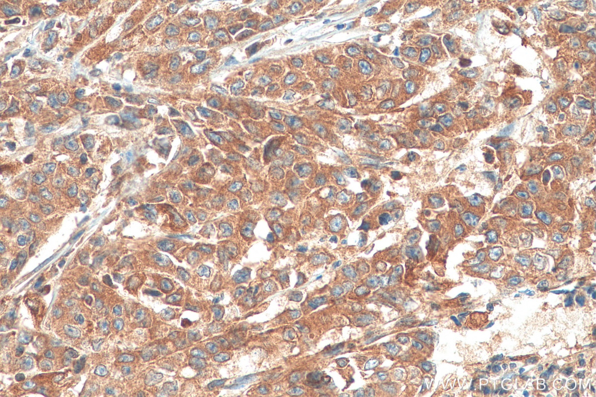 IHC staining of human stomach cancer using 81196-1-RR