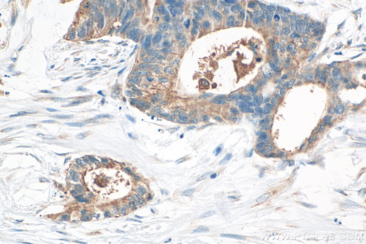 Immunohistochemistry (IHC) staining of human urothelial carcinoma tissue using ACSL6 Polyclonal antibody (13847-1-AP)
