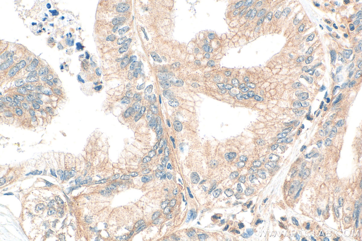 Immunohistochemistry (IHC) staining of human pancreas cancer tissue using ACSL6 Polyclonal antibody (13847-1-AP)
