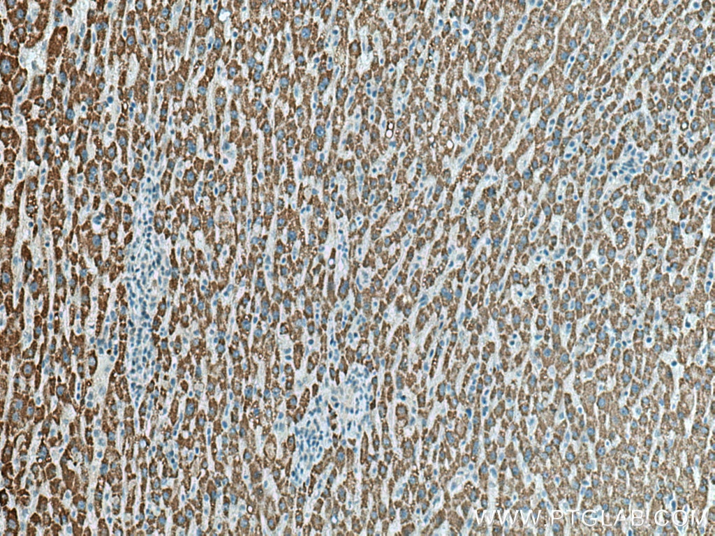 Immunohistochemistry (IHC) staining of human liver cancer tissue using ACSM2A Polyclonal antibody (22862-1-AP)