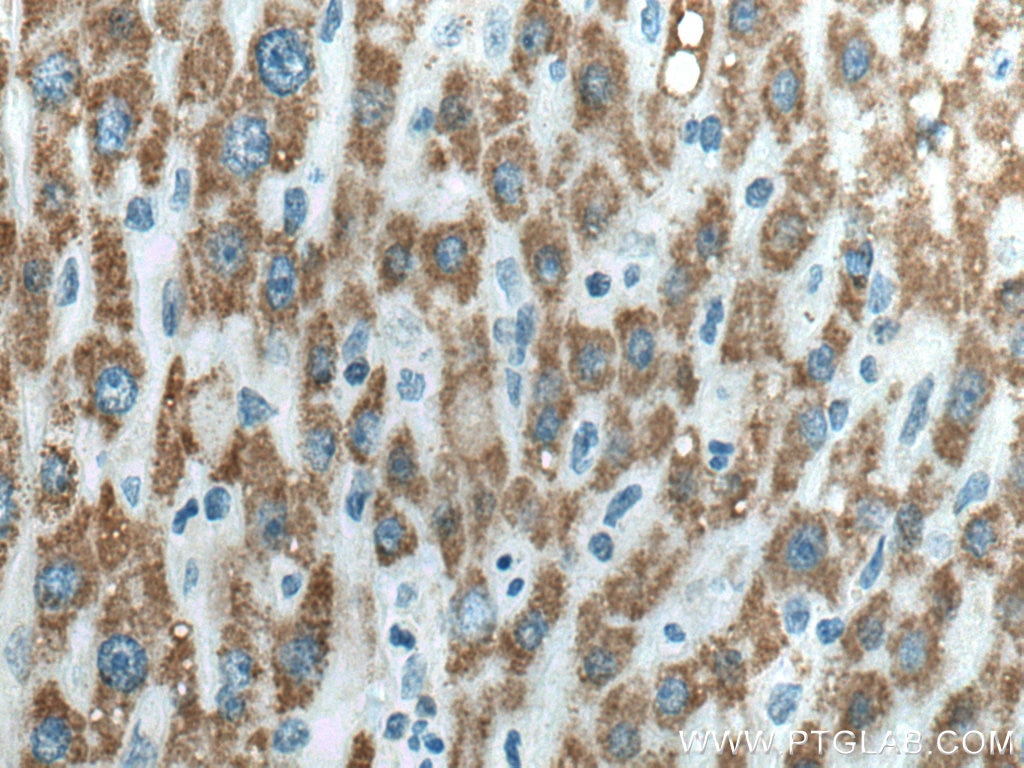 Immunohistochemistry (IHC) staining of human liver cancer tissue using ACSM2A Polyclonal antibody (22862-1-AP)