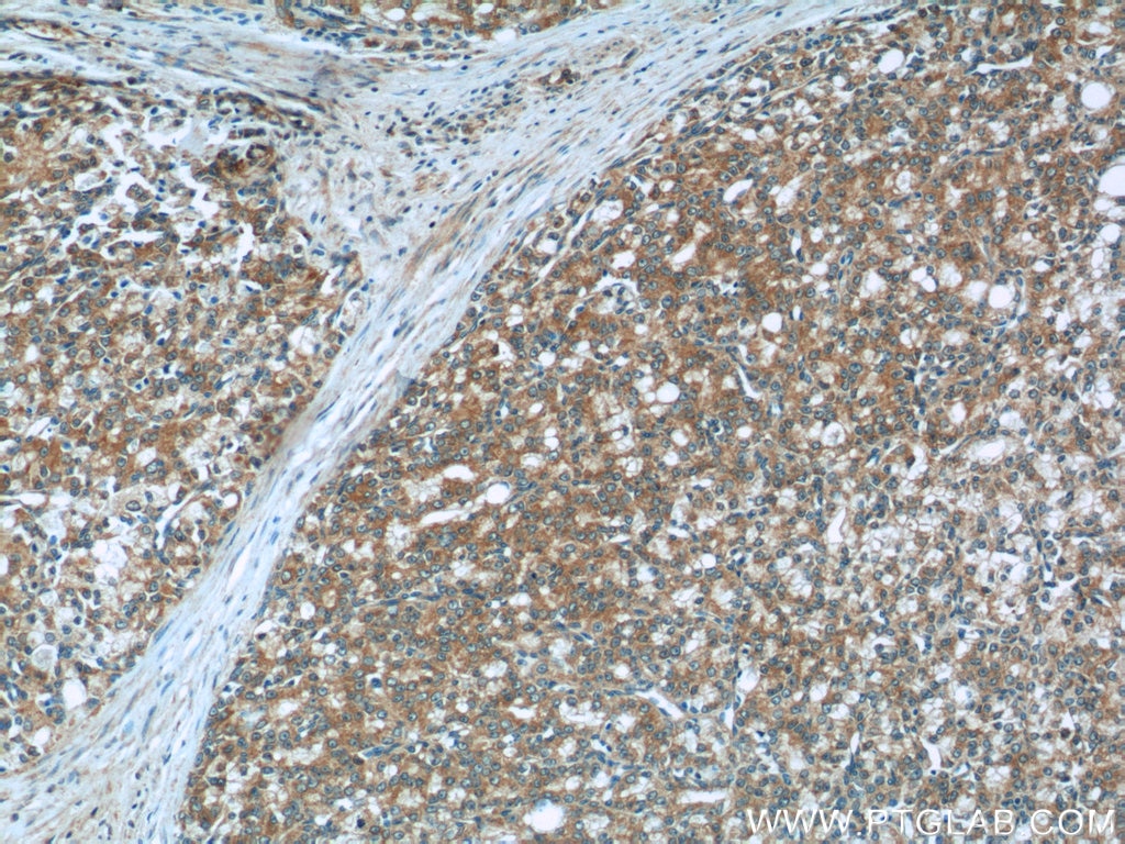 Immunohistochemistry (IHC) staining of human prostate cancer tissue using ACSM3 Polyclonal antibody (10168-2-AP)