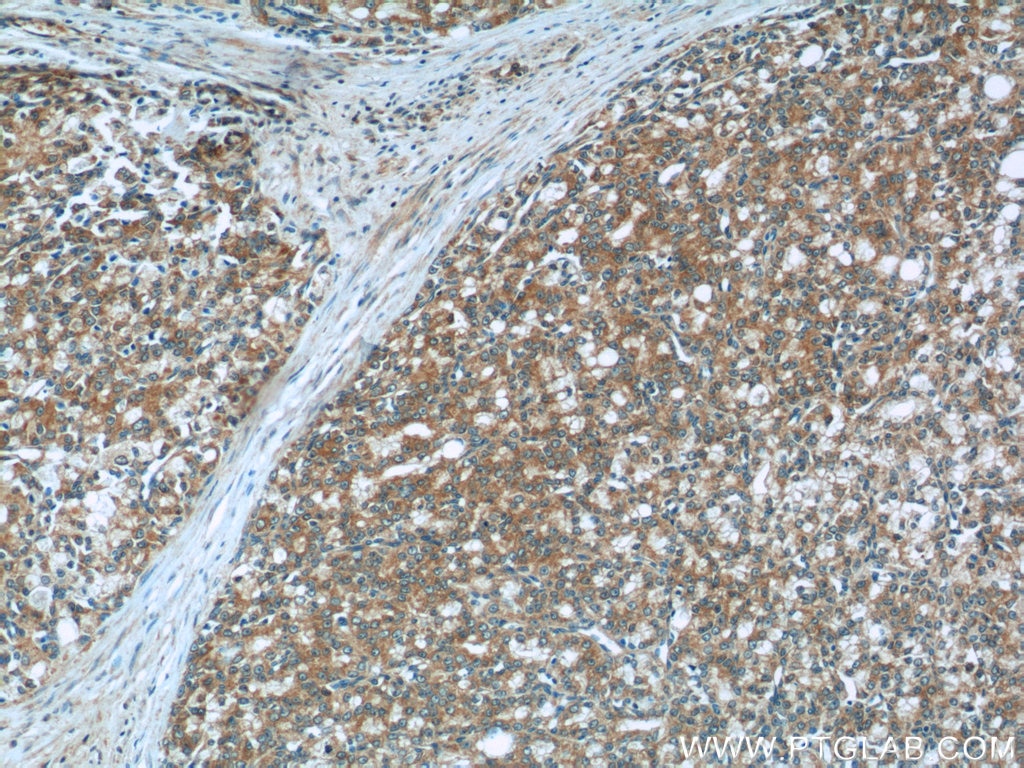 IHC staining of human prostate cancer using 10168-2-AP