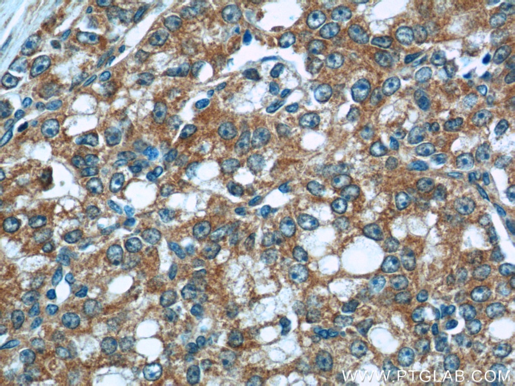 IHC staining of human prostate cancer using 10168-2-AP