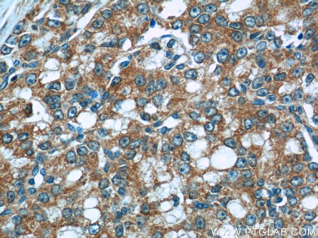 Immunohistochemistry (IHC) staining of human prostate cancer tissue using ACSM3 Polyclonal antibody (10168-2-AP)